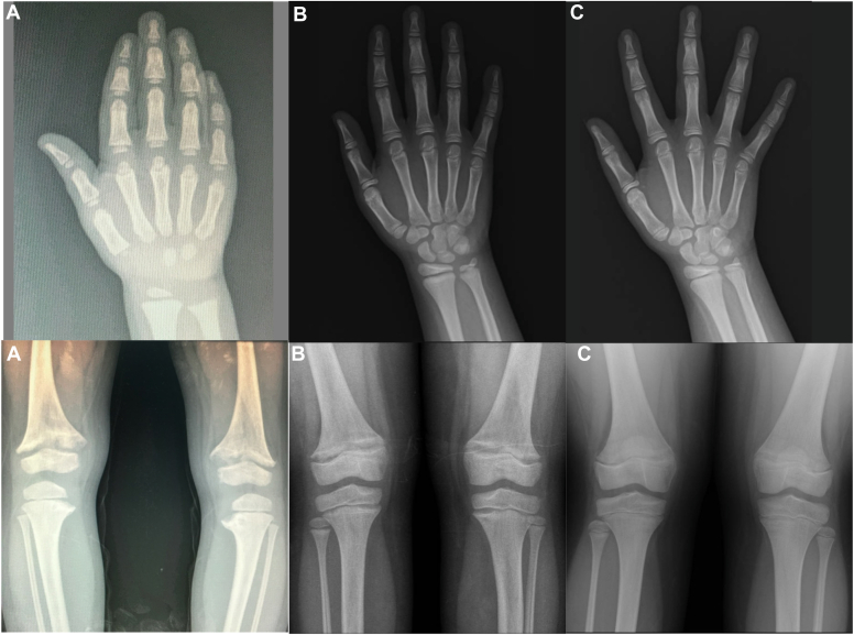 Combined Treatment With Leuprolide Acetate and Burosumab in X-linked Hypophosphatemia and Precocious Puberty: A Therapeutic Response
