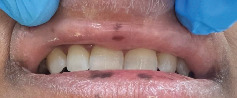 Lip Melanosis Postdermal Filler Injection: Second Case Report and Literature Review.