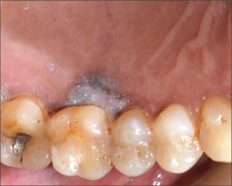 Management of leukoplakia of palatal gingiva using free gingival graft.