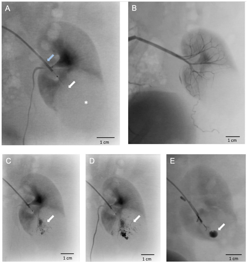 Trans-Vessel Wall Cell Transplantation, Engraftment, and Tumor Access in the VX2 Rabbit Model.