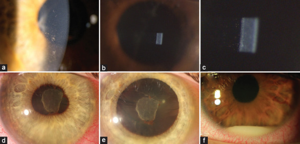 A review on anterior uveitis and spondyloarthritis with a focus on the interdisciplinary approach between ophthalmologists and rheumatologists.