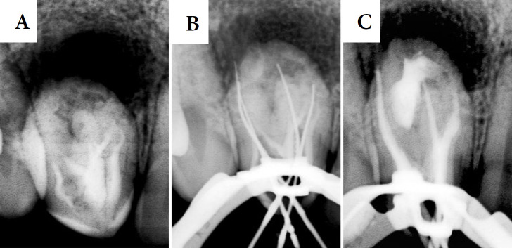 Endodontic Treatment of an Upper Lateral Incisor with Oehlers' Type II Dens Invaginatus: A Case Report.