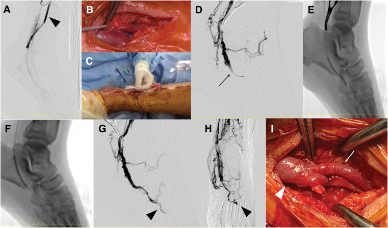 Combined Arterial Reconstruction and Surgical Distal Venous Arterialization for Limb Salvage in Thromboangiitis Obliterans: A Case Report.