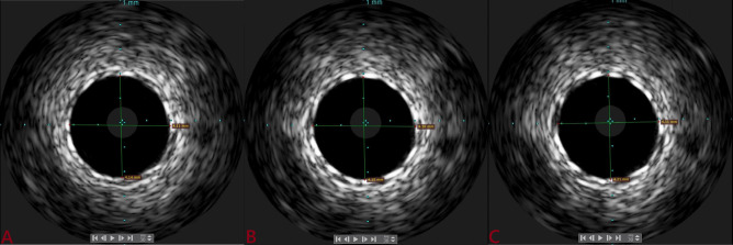 Evaluation of novel ultrathin, biodegradable polymer tetriflex (sirolimus-eluting stent) optimization using intravascular ultrasound (IVUS) in short coronary lesion (≤ 20mm) vs. long coronary lesion (≥ 20mm): Tetriflex IVUS study.
