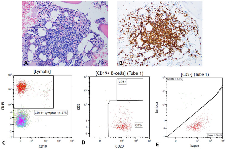 Acquired Angioedema as the First Sign of Lymphoproliferative Disorder: Case Report and Review of Literature.