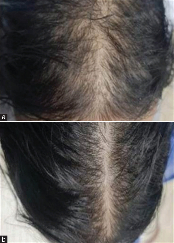 Evaluation of the Efficacy and Safety of Topical Spironolactone versus Topical Minoxidil in the Treatment of Female Pattern Hair Loss: A Comparative, Clinical, and Trichoscopic Study.