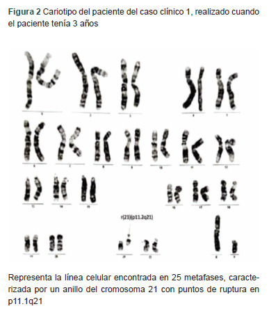 [Ring chromosome 21 syndrome: report of 2 cases].