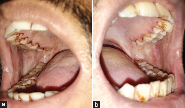 Correlation of blanching, fibrosis, and uvular changes with the extent of mouth opening in oral submucous fibrosis - A 9-year retrospective analysis.