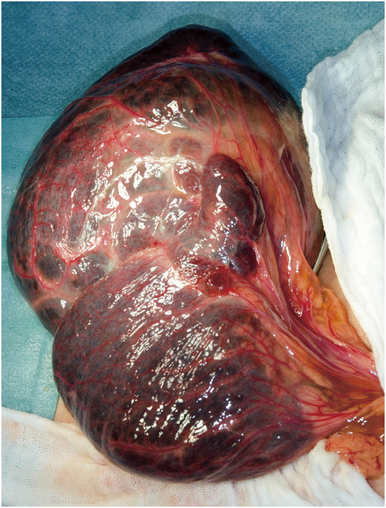 Benign Cystic Mesothelioma of the Peritoneum Arising at the Greater Omentum in a 14-Year-Old Boy.