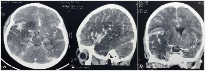Cerebral Venous Sinus Thrombosis and Helminthiasis. A Case-Based Review.