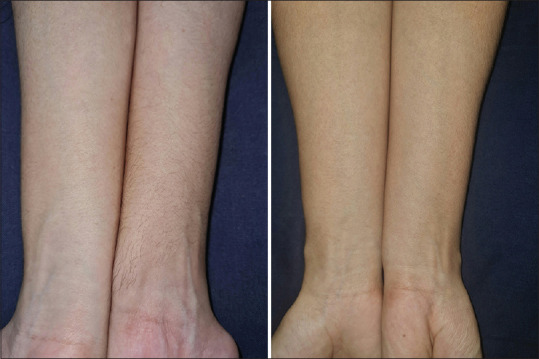 Acquired Localized Hypertrichosis Following Cast Application for Fracture.