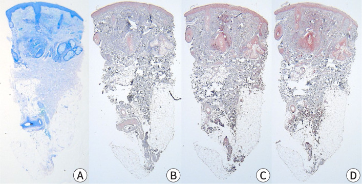 No difference in inflammatory mediator expression between mast cell-rich and mast cell-poor rosacea lesions in Korean patients: a comparative study.