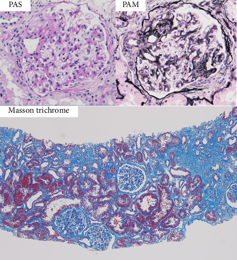 A Case of IgA Nephropathy in a Patient With Sarcoidosis: Confirmation of Glomerular Galactose-Deficient IgA1 Deposition.