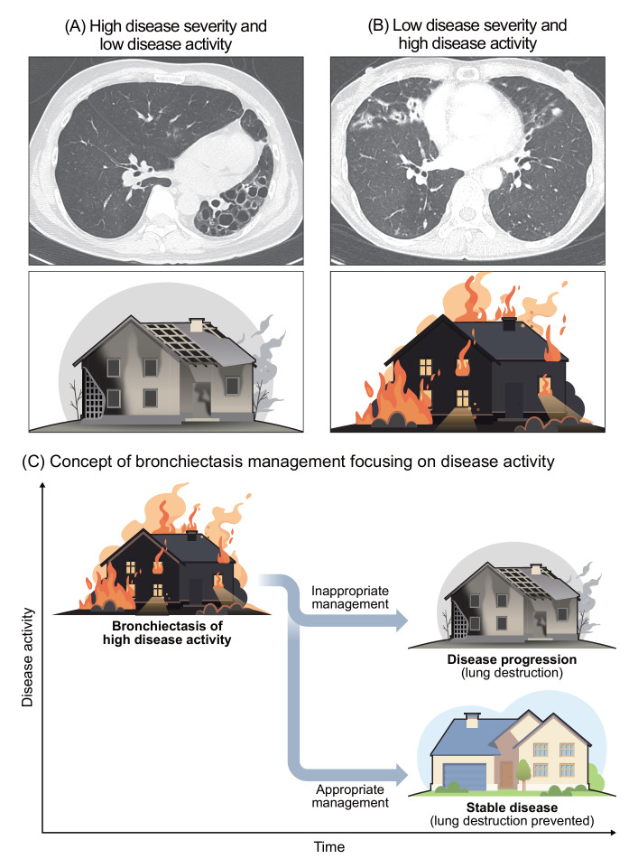 Disease Severity and Activity in Bronchiectasis: A Paradigm Shift in Bronchiectasis Management.