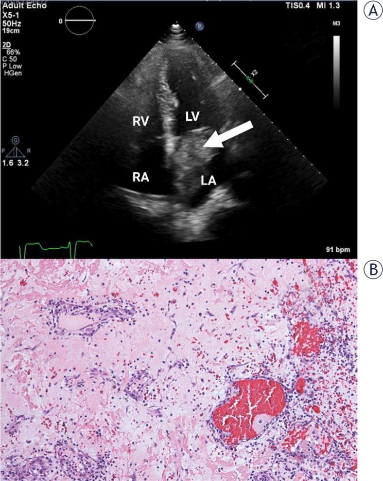 Accuracy of transthoracic echocardiography in diagnosis of cardiac myxoma: single center experience.