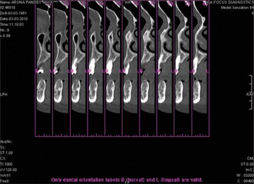 Bone mineral density as a criterion for primary implant stability: A retrospective CBCT analysis.