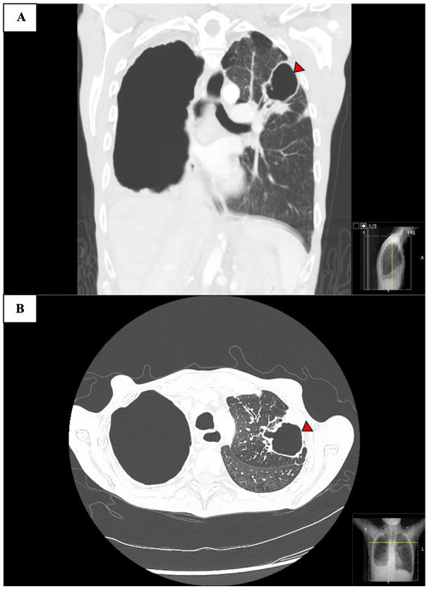 Concurrent Coccidioidomycosis and <i>Mycobacterium abscessus</i> Infection in Chronic Obstructive Pulmonary Disease.