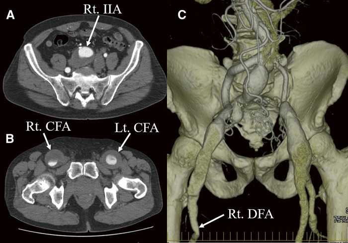Common Femoral Artery Aneurysm: A Rare Manifestation of Immunoglobulin G4-Related Disease.
