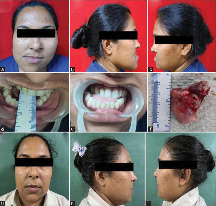 Osteochondroma of the condyle of the mandible: A case report.