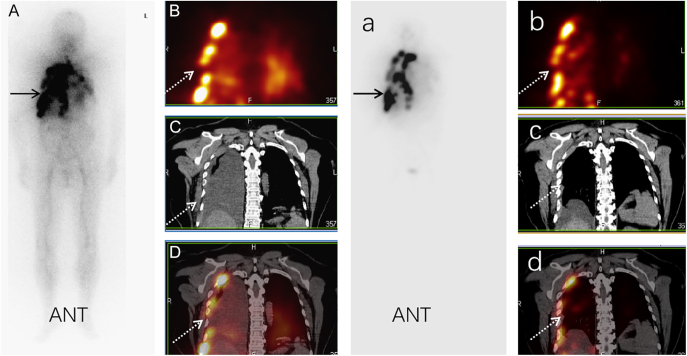 Pleural metastases from differentiated thyroid cancer: clinical features and long-term outcomes.