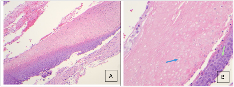 Case report: Periorbital pilomatricoma: a rare benign skin tumor misdiagnosed as cellulitis.