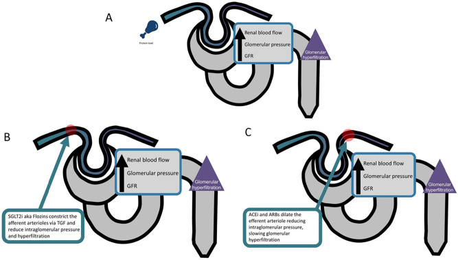 Protein restriction in CKD: an outdated strategy in the modern era.