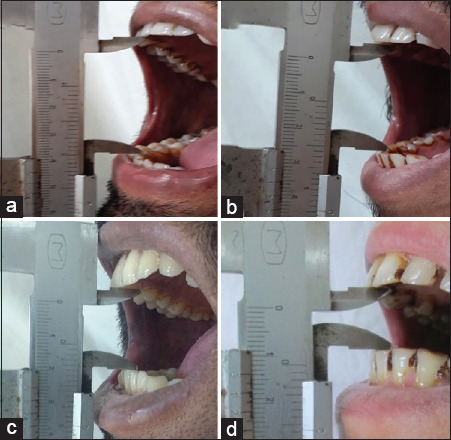 Correlation of blanching, fibrosis, and uvular changes with the extent of mouth opening in oral submucous fibrosis - A 9-year retrospective analysis.