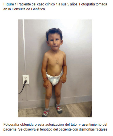 [Ring chromosome 21 syndrome: report of 2 cases].
