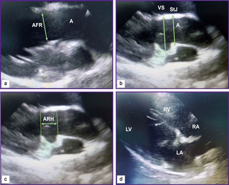 Functional Anatomy of the Sheep Heart as a Model for Testing Cardiovascular Devices.