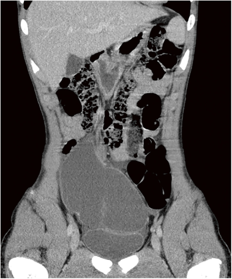 Benign Cystic Mesothelioma of the Peritoneum Arising at the Greater Omentum in a 14-Year-Old Boy.