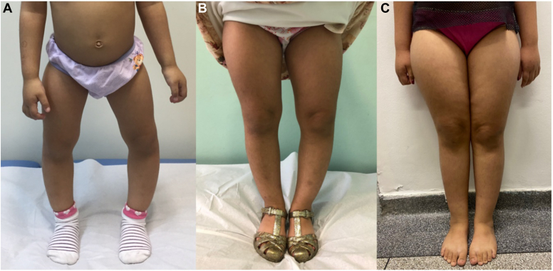 Combined Treatment With Leuprolide Acetate and Burosumab in X-linked Hypophosphatemia and Precocious Puberty: A Therapeutic Response