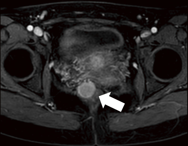 Robot-Assisted Ultra-Low Anterior Resection for Rectal Neuroendocrine Tumors after Severe Perineal Tears: A Case Report.