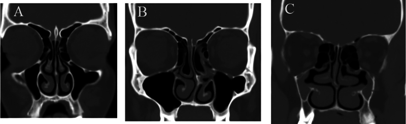 Description of the Uncinate Process: A Computed Tomography Cross-Sectional Study.