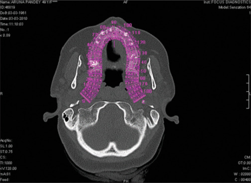 Bone mineral density as a criterion for primary implant stability: A retrospective CBCT analysis.