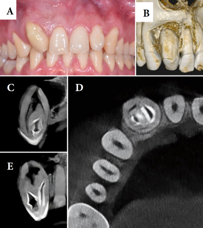Endodontic Treatment of an Upper Lateral Incisor with Oehlers' Type II Dens Invaginatus: A Case Report.