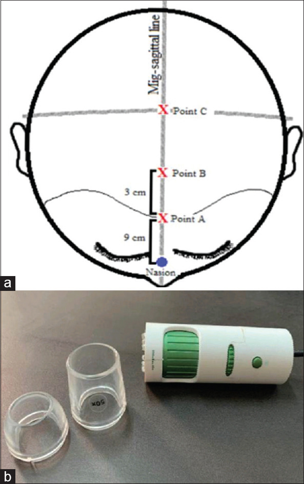 Evaluation of the Efficacy and Safety of Topical Spironolactone versus Topical Minoxidil in the Treatment of Female Pattern Hair Loss: A Comparative, Clinical, and Trichoscopic Study.