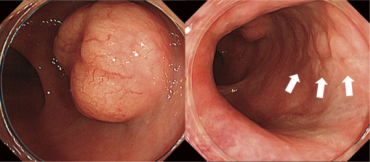 Robot-Assisted Ultra-Low Anterior Resection for Rectal Neuroendocrine Tumors after Severe Perineal Tears: A Case Report.