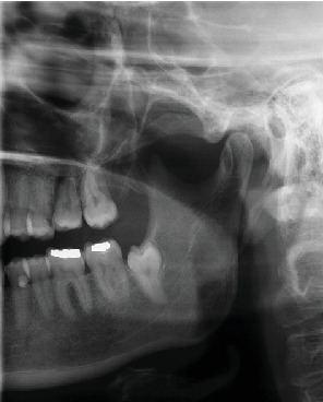 Revascularization of an Autotransplanted Mature Tooth After Extraoral Root Resection: A Case Report.