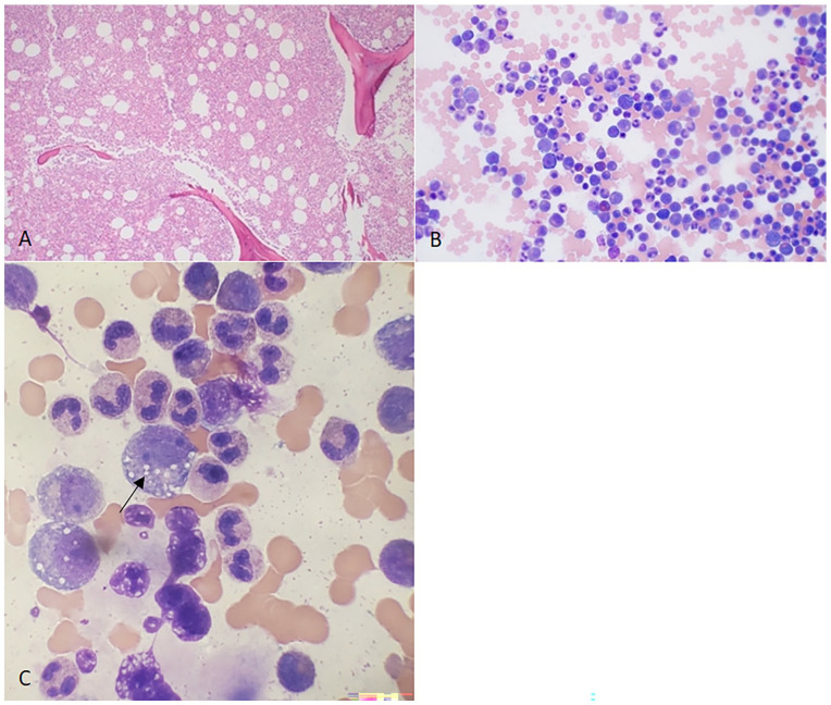 The Challenging and Unique Diagnosis of VEXAS Syndrome: A Case Report.