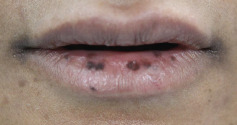 Lip Melanosis Postdermal Filler Injection: Second Case Report and Literature Review.