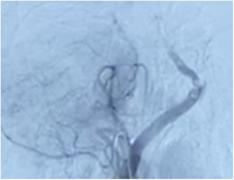 Beyond the Limit: Salvaging the Posterior Circulation Territory via Late Endovascular Thrombectomy.