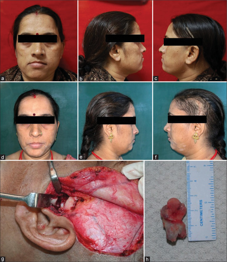 Osteochondroma of the condyle of the mandible: A case report.