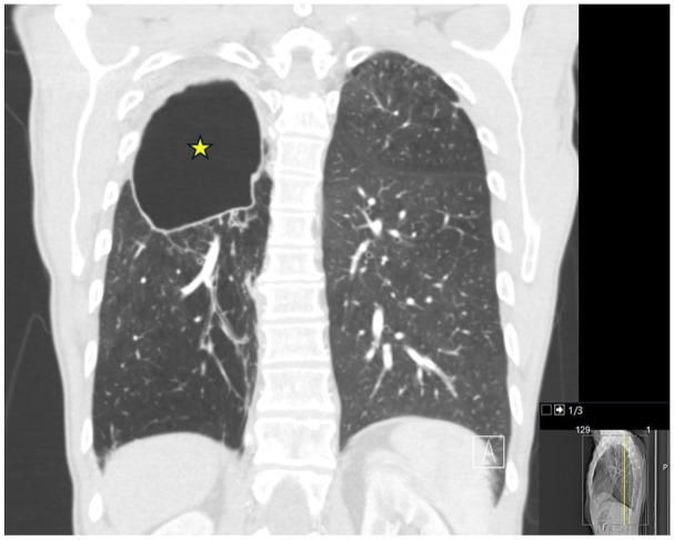 Concurrent Coccidioidomycosis and <i>Mycobacterium abscessus</i> Infection in Chronic Obstructive Pulmonary Disease.