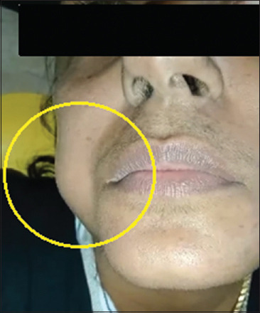 Angioleiomyoma of cheek - A case report highlighting immunohistochemical diagnostic approach.