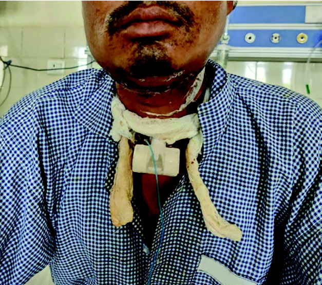 Self-Inflicted Cut-Throat Injuries in Psychiatric Patients During the COVID-19 Pandemic: A Report of Two Rare Cases.