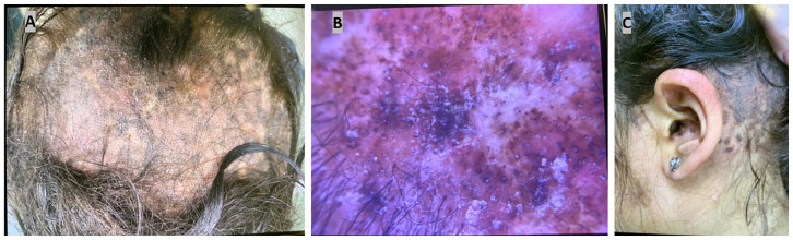 Case Report: Two Cases of Kikuchi Disease in West Texas With Non-Self-Limited Disease.