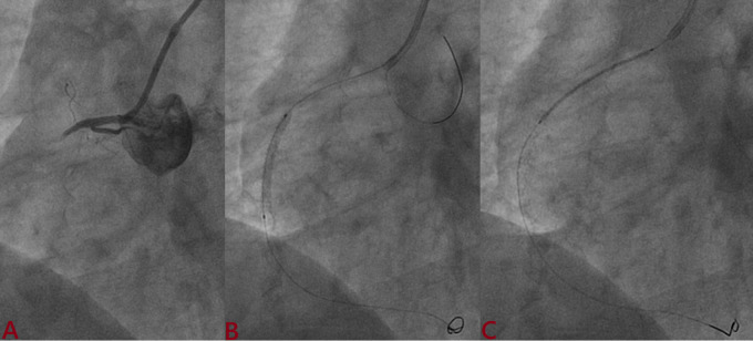 Evaluation of novel ultrathin, biodegradable polymer tetriflex (sirolimus-eluting stent) optimization using intravascular ultrasound (IVUS) in short coronary lesion (≤ 20mm) vs. long coronary lesion (≥ 20mm): Tetriflex IVUS study.