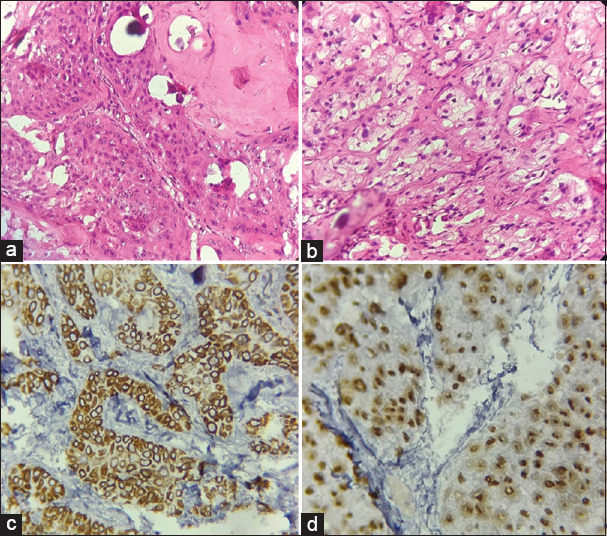 Unravelling a solitary gingival swelling: A unique case report of clear cell calcifying epithelial odontogenic tumour.