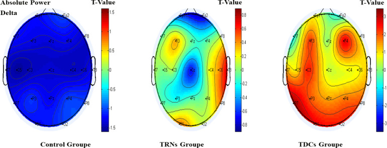 Enhancing EEG Components in Adolescents With ADHD Using Transcranial Electrical Stimulation: A Randomized-active Controlled Study.