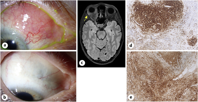 Nodular Scleritis as Isolated Symptom of IgG4-Related Disease, Mimicking as Conjunctival Lymphoma: A Case Report.